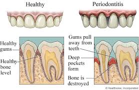 Gum Disease Process|Menston Dental|Guiseley|Ilkley|Leeds|Bradford