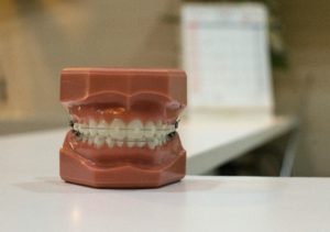 A denture with braces on a white table