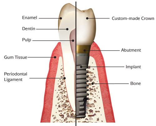 From Gap to Confident Bite: A Simple Step-by-Step Guide to Dental Implants