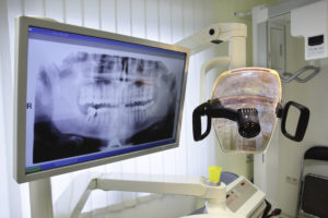 Dental implants made clear: 3D planning and custom guides for accurate placement